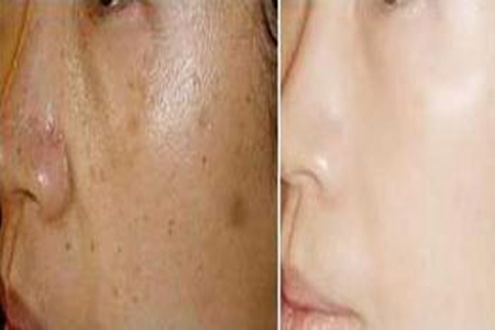 简单去宫颈息肉方法
