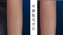 怎样脱去手毛