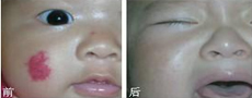 去除红内分泌失调